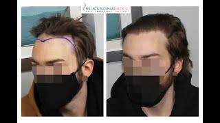 Widows Peak, Hairline, And Temple Hair Transplant Did It Work? Feller & Bloxham Medical, Ny