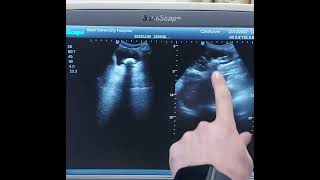 Left Renal Middle Calyx Calculus With Mild Hydronephrosis & Urinary Bladder Stone