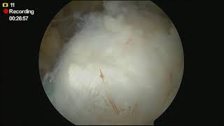Acromioclavicular and Coracoclavicular Ligament Reconstruction with Xiros Infinity Lock