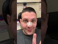 Septorhinoplasty/Sinus Surgery 24 hours ago