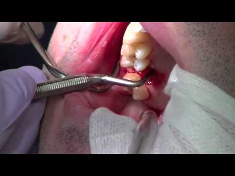 Physics Forceps Upper Molar Tooth Extraction, Cytoplast Barrier