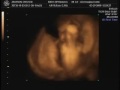 Layla Grace Wilkinson ultrasound