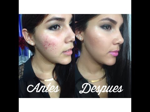maquillaje antes y despues acne