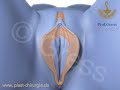 Composite Reduction Labiaplasty: Labia + Cltitoral Hood Reduction, correction of clitoral protrusion