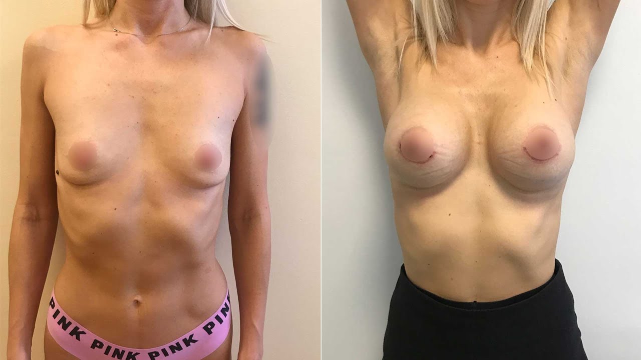Xxx A Fake Tits Implants Silicone Pierced Navel Hard Nipples Erect