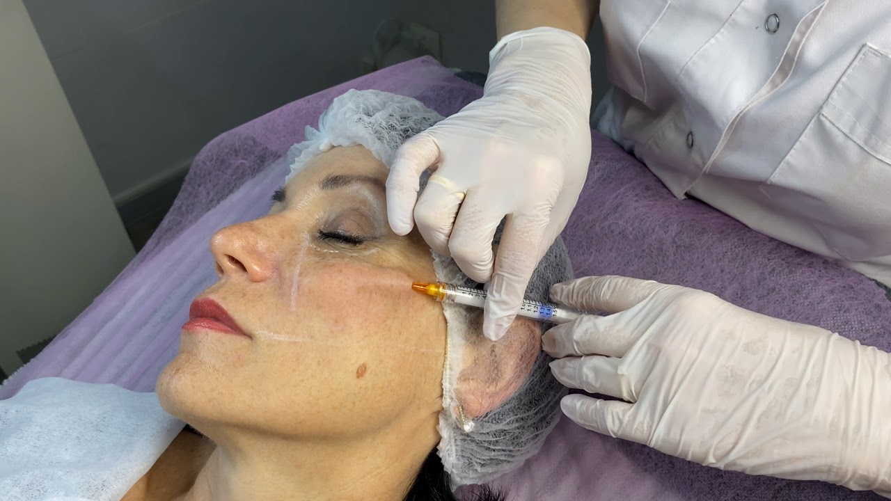 Radiesse facial filler globular filler opinions