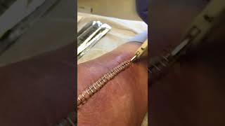 Staple Removal, Jan’s left knee replacement.