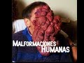 Malformaciones Humanas