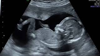 Baby With Hiccups