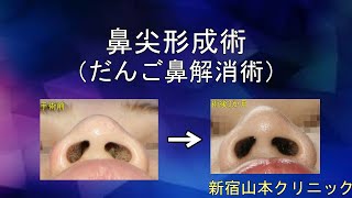 団子鼻解消術(鼻尖形成・鼻尖軟骨縛り)山本クリニック