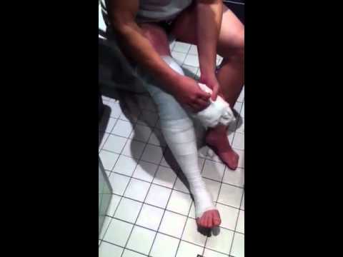 Question - ACL Surgery (when can I walk.