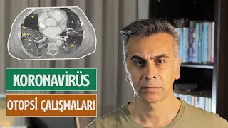 Koronavirüs Otopsi Çalışmaları | Virüs Hangi Organlara Zarar Veriyor?