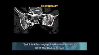 Ucsf Radiology Vertebral Bodies And Sacral Fractures