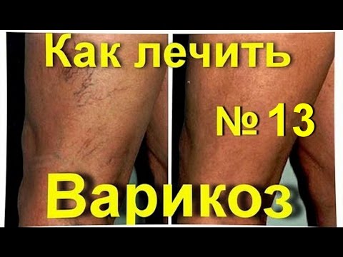 Лечить варикоз народными средствами в домашних условиях