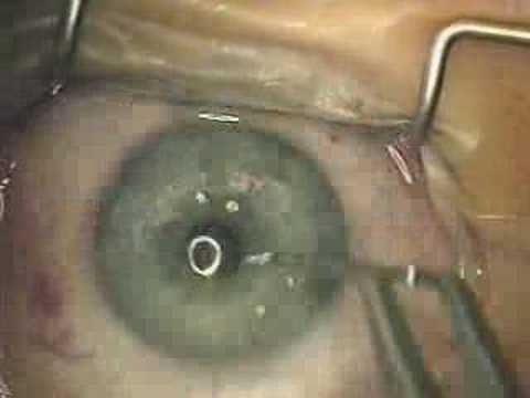INTACS : Keratocône / Keratoconus (Magali Beauregard)