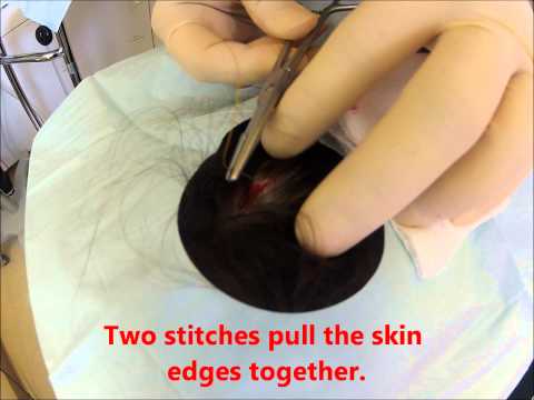 Office Procedure Scalp Sebaceous Cyst Removal