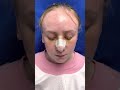 Post op Septorhinoplasty Sinus Surgery Tonsillectomy 4 days ago with minimal bruising