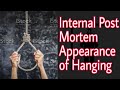 Internal Post-Mortem Appearance of Hanging || Forensic Medicine