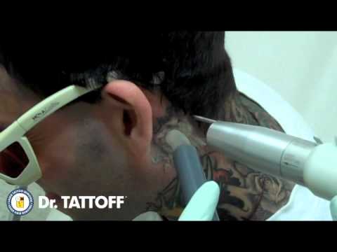 tattoo removal behind ear laser tattoo removal in dallas tattoo removal behind ear laser tattoo removal in dallas