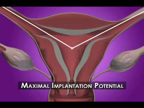 3D/4D Ultrasound-Guided Embryo Transfer to the MIP Point