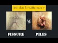 Piles vs Fissure - Difference ?