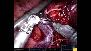 Robotic Assisted Right Lower Lobectomy Following Immunotherapy and Post-Oesophagectomy