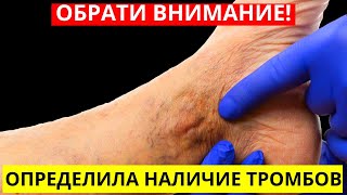 Смертельно Опасные Тромбы Вот Как Понять, Есть Ли У Вас Тромбы