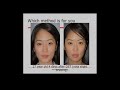 Non Cutting vs Incision Asian eyelid surgery Dr. Charles Lee