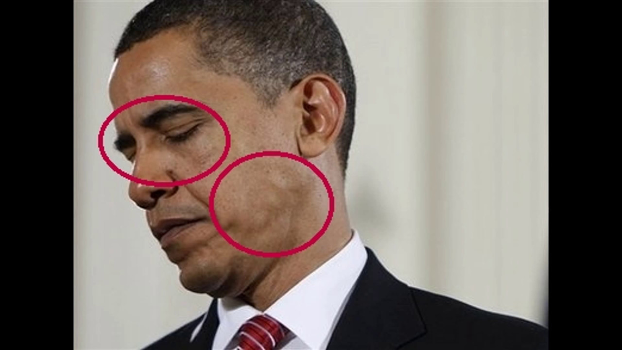 Facial tumor barack obama inspiration