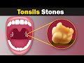 What are Tonsil stones?