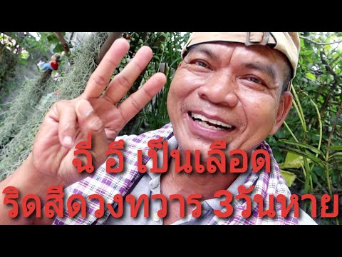 ริดสีดวงทวาร ฉี่เป็นเลือด อึเป็นเลือด 3วันหาย