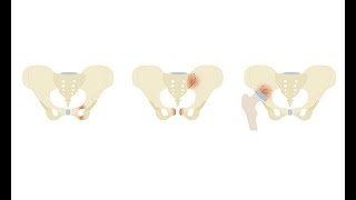 Investigating Pelvic Fractures On Ct