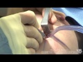 Breast Implants Removal