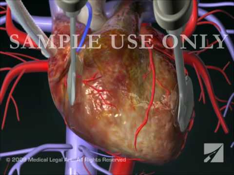 Coronary Artery Bypass Graft (CABG) Procedure - YouTube