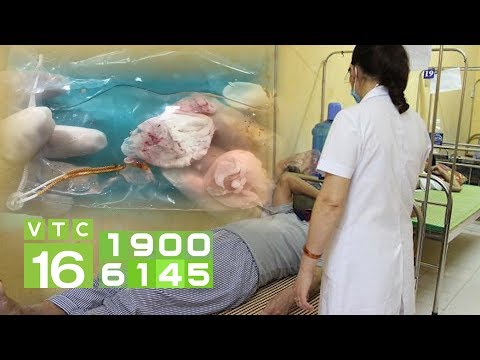 Liệt nửa người vì ổ sán khổng lồ trong não | VTC16