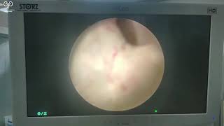 Tur-P Əməliyyatı Uzman Uroloq-Androloq Dr.emin Məmmədov