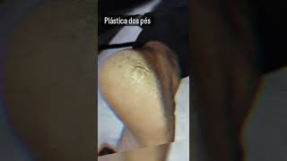 Plástica Dos Pés