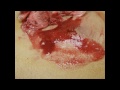 Abscess Incision & Drainage with Sac Removal
