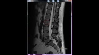 Interactive-Cut Real-Time Segmentation Of Vertebral Bodies And Discs