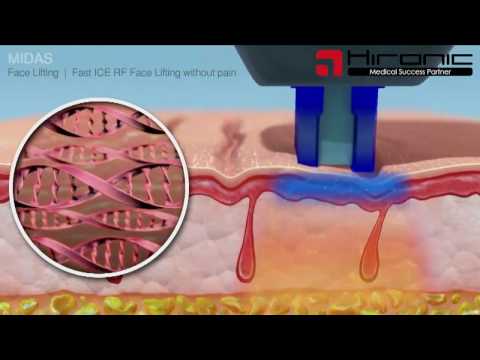 Thiết bị thẩm mỹ Bemed - New Midas - Máy giảm béo, trẻ hóa da, nâng cơ hàng đầu Việt Nam