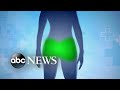 The dark side of illegal buttock injections | Nightline