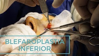 ¿Que es y como se hace una BLEFAROPLASTIA INFERIOR?