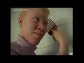 S.A. witchdoctors are recommending albino-sex to cure AIDS