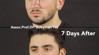 Closed Atraumatic Rhinoplasty For Male Patients