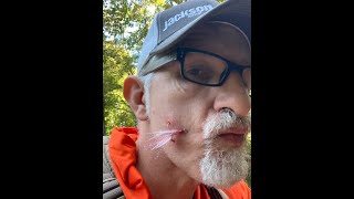 Directors Cut How To Remove A Treble Hook From Your Face