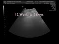 Ultrasound Video- Part One, 12 Weeks & 2 Days... It's a girl! 10/15/12