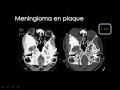 Imaging of Brain tumors   Dr Mamdouh Mahfouz In Arabic