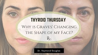 Why Is Graves' Disease Changing The Shape Of My Face? |  Dr. Raymond Douglas