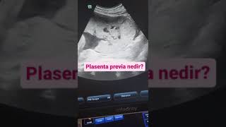 Plasenta Previa Nedir? - Op. Dr. Gülşah Tanas Sarıkaş