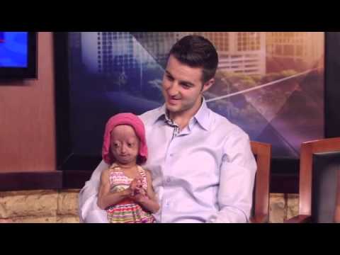 Adalia Rose 6 Year Old With Premature Aging Promotes